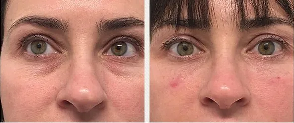 Patient Before & immediately After 0.6cc of Restylane-L to the tear trough for under eye volumization
