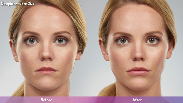 Treated with 1cc of Voluma to the cheeks 0.8cc of Juvederm Ultra Plus XC to the lips