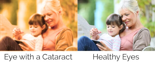 example of cataract vs regular vision