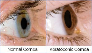 normal vs keratoconic cornea