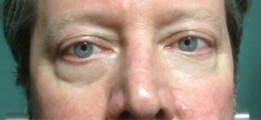 rosacea treatment results