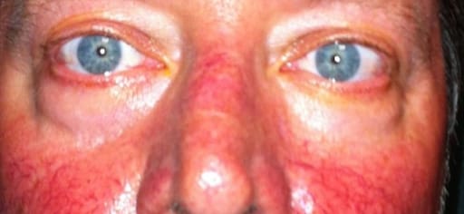 person with severe rosacea