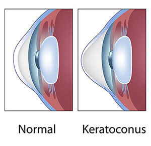 Keratoconus example