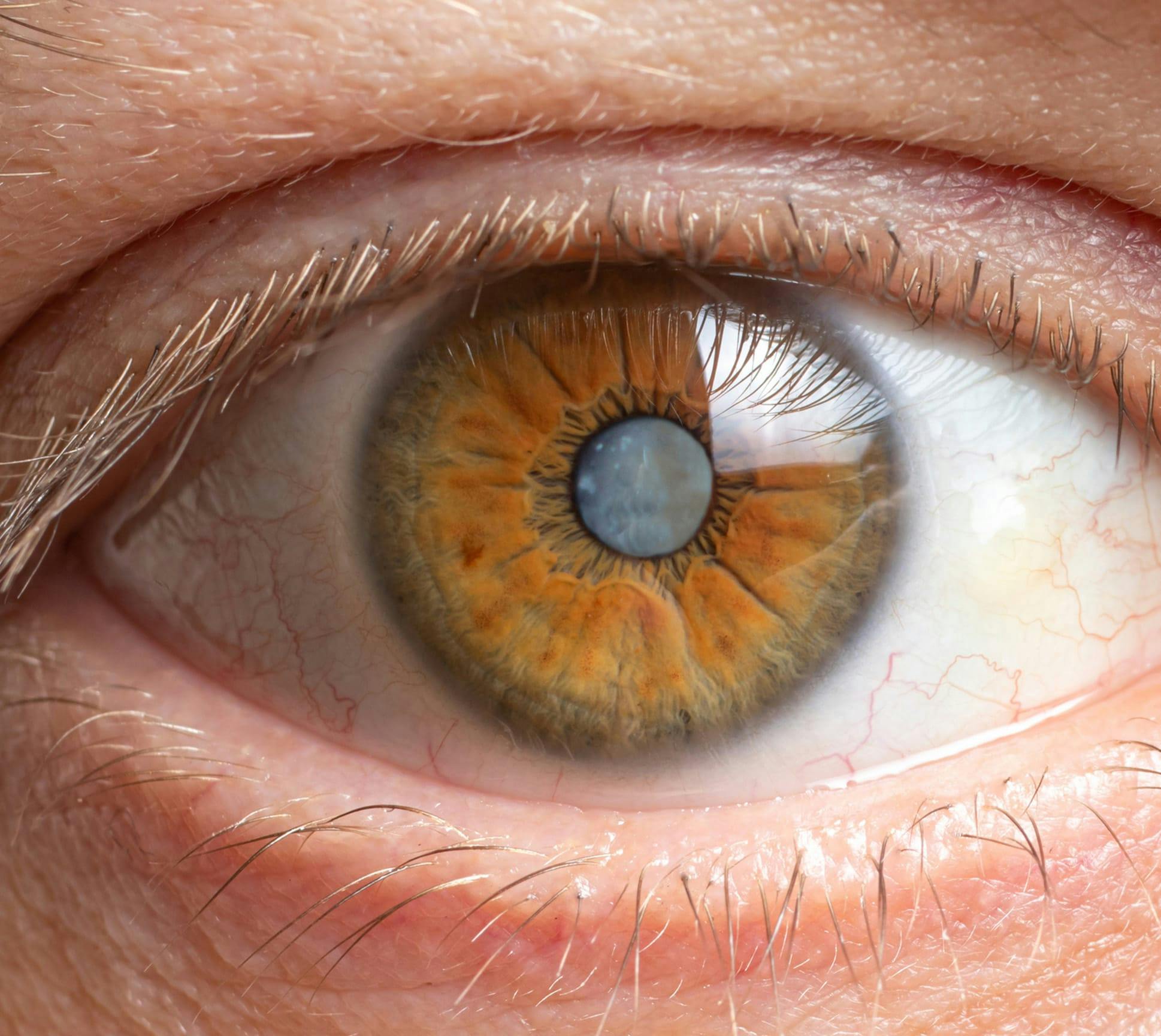 hazel eye