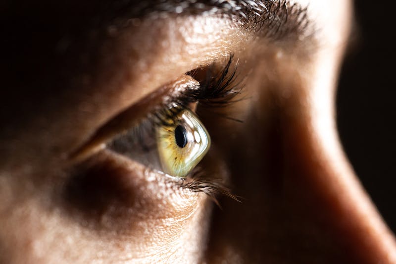 close up of eyeball with Keratoconus
