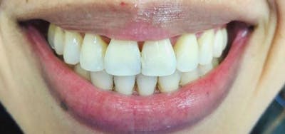 Smile Makeover Before & After Gallery - Patient 152861242 - Image 2