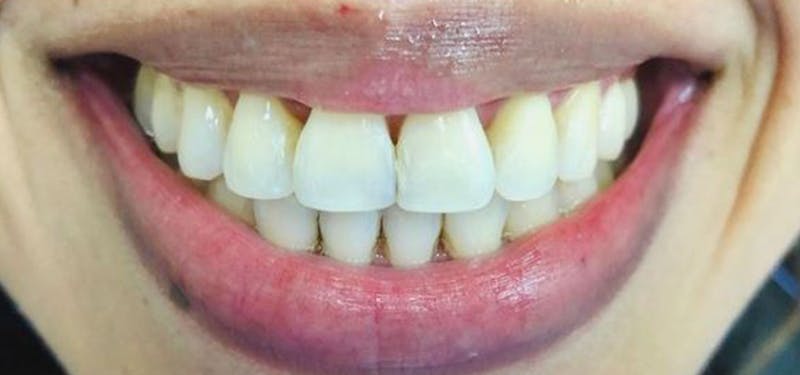 Smile Makeover Before & After Gallery - Patient 152861242 - Image 2