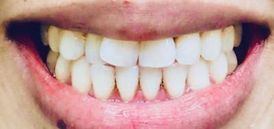 Smile Makeover Before & After Gallery - Patient 152861242 - Image 1