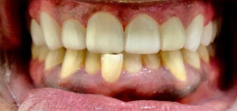 Smile Makeover Before & After Gallery - Patient 152861243 - Image 2