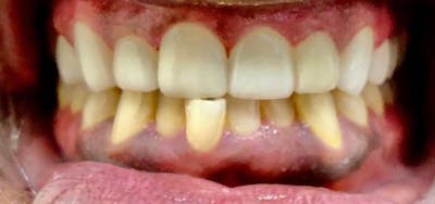 Smile Makeover Before & After Gallery - Patient 152861243 - Image 2