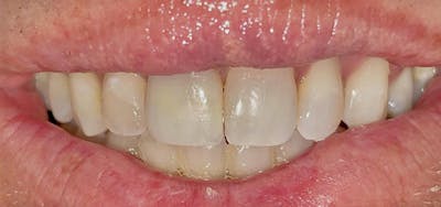 Smile Makeover Before & After Gallery - Patient 152861258 - Image 2
