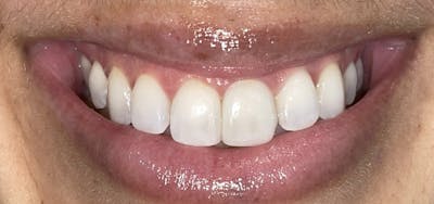 Smile Makeover Before & After Gallery - Patient 152861257 - Image 2