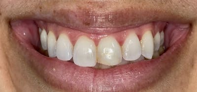 Smile Makeover Before & After Gallery - Patient 152861257 - Image 1