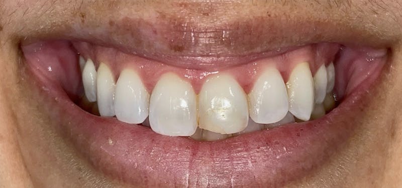Smile Makeover Before & After Gallery - Patient 152861257 - Image 1