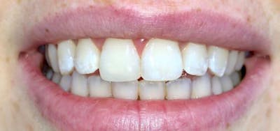 Smile Makeover Before & After Gallery - Patient 152861247 - Image 2