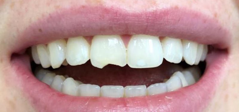 Smile Makeover Before & After Gallery - Patient 152861247 - Image 1