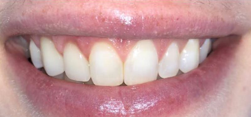 Smile Makeover Before & After Gallery - Patient 152861246 - Image 2