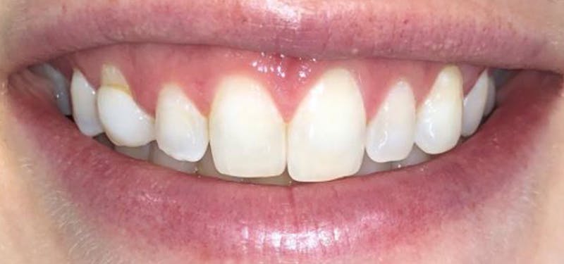 Smile Makeover Before & After Gallery - Patient 152861246 - Image 1