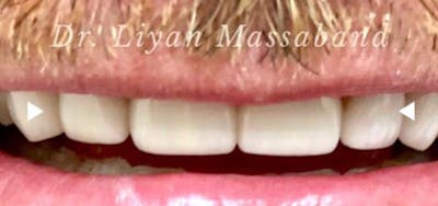 Smile Makeover Before & After Gallery - Patient 152861245 - Image 2