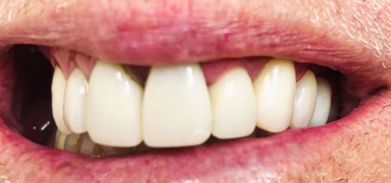 Smile Makeover Before & After Gallery - Patient 152861244 - Image 2
