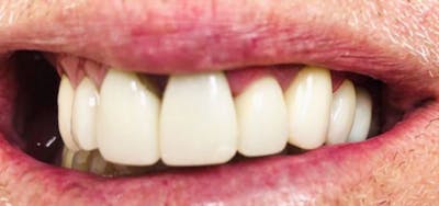 Smile Makeover Before & After Gallery - Patient 152861244 - Image 2