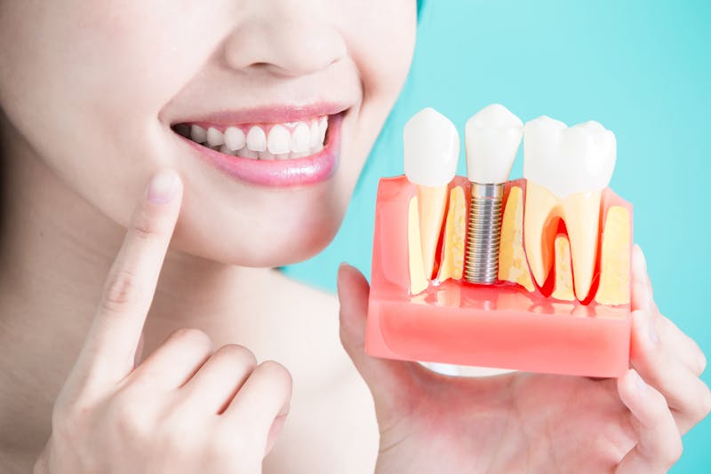 How do Dental Implants Feel and Am I a Candidate?