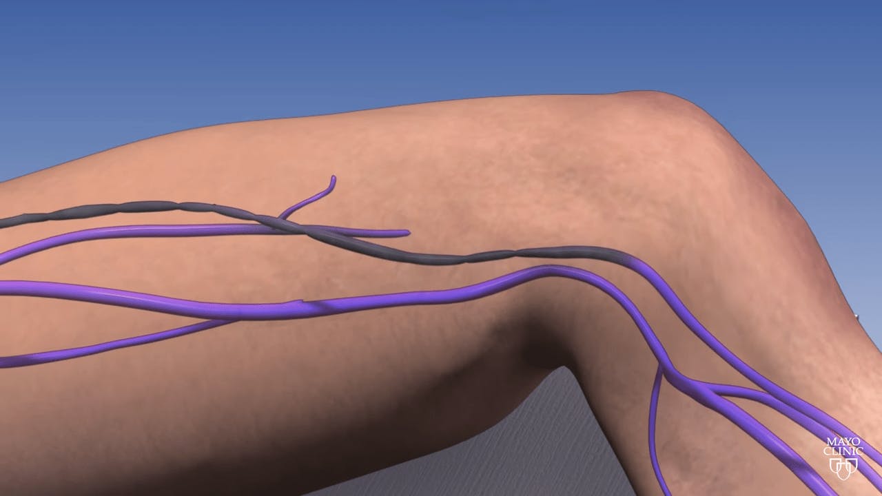 A diagram of varicose vein treatment in Tampa.