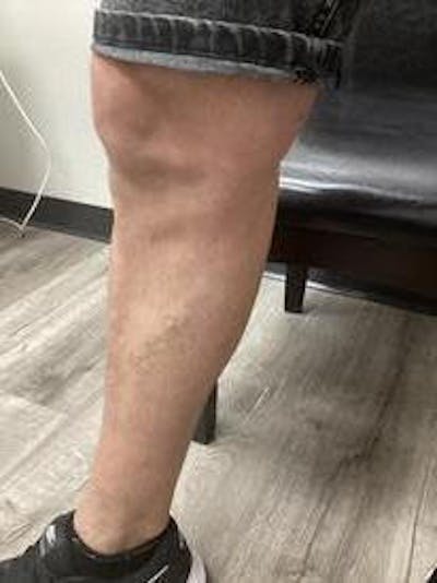 Vein Ablation Before & After Gallery - Patient 158714369 - Image 2