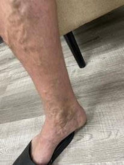 Vein Ablation Before & After Gallery - Patient 158714369 - Image 1