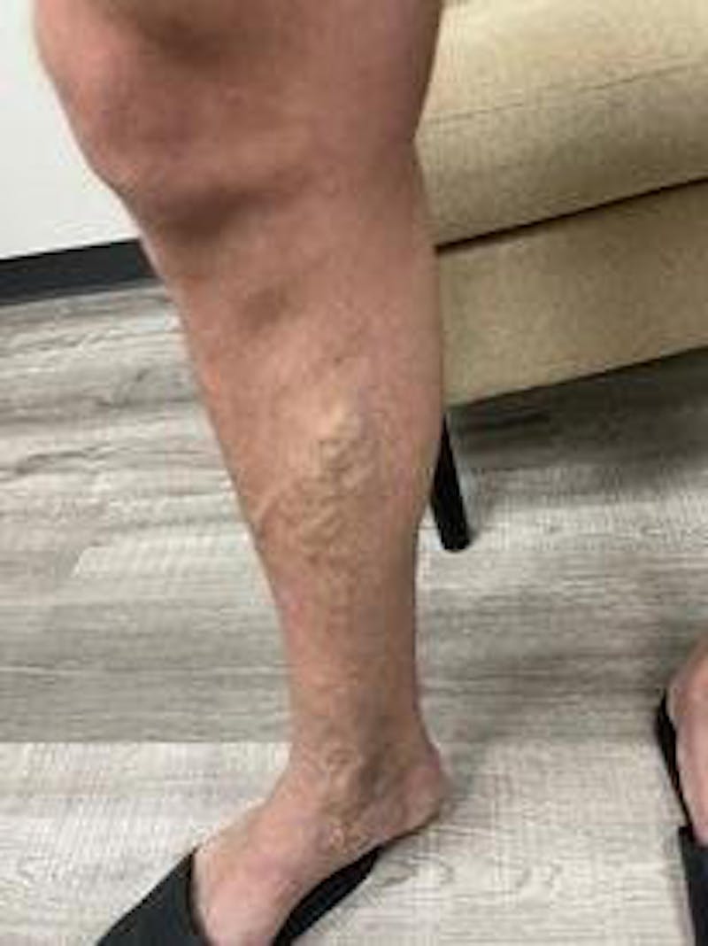 Vein Ablation Before & After Gallery - Patient 158714369 - Image 3