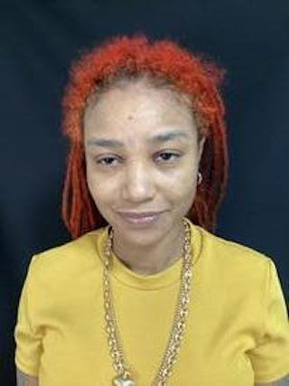 Laser Genesis Before & After Gallery - Patient 158714421 - Image 4