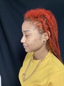 Laser Skin Rejuvenation Before & After Gallery - Patient 158714421 - Image 2