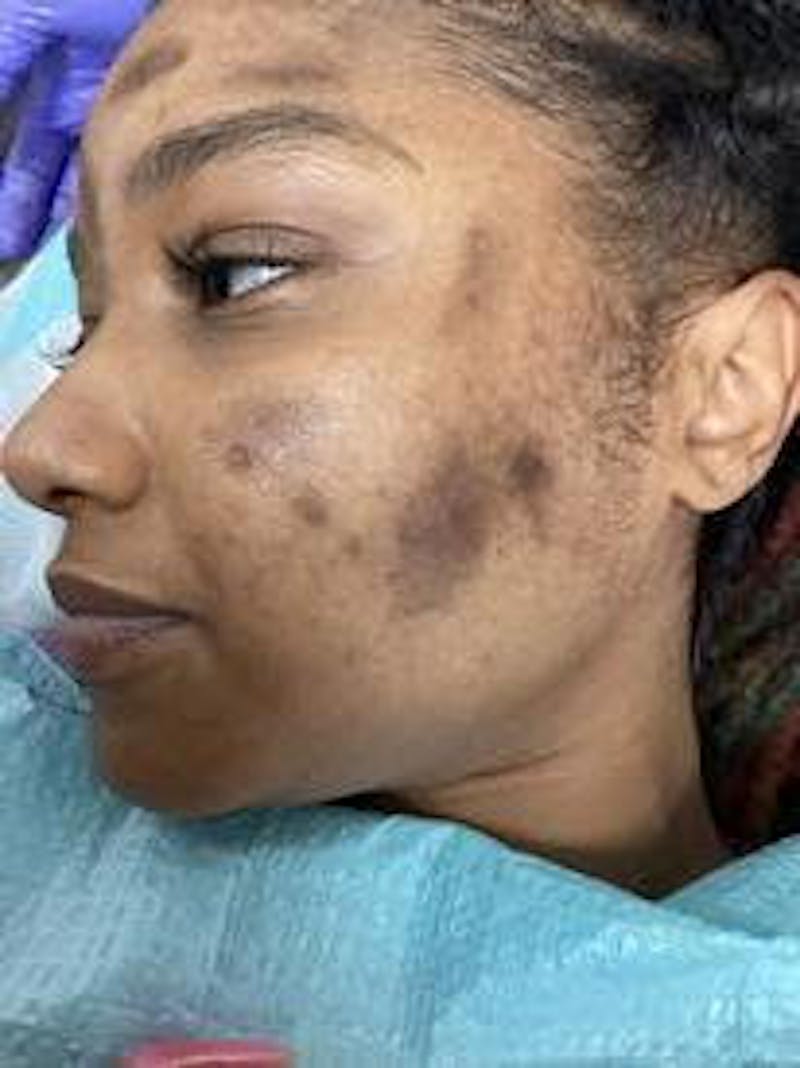 Laser Genesis IPL Before & After Gallery - Patient 158714421 - Image 1