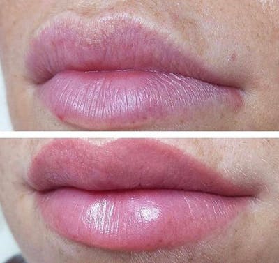 Lip Blushing Before & After Gallery - Patient 195959116 - Image 1