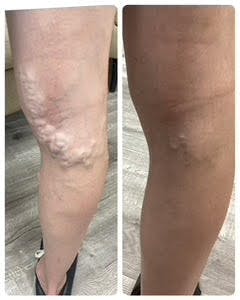 Vein Ablation Before & After Gallery - Patient 198432555 - Image 1