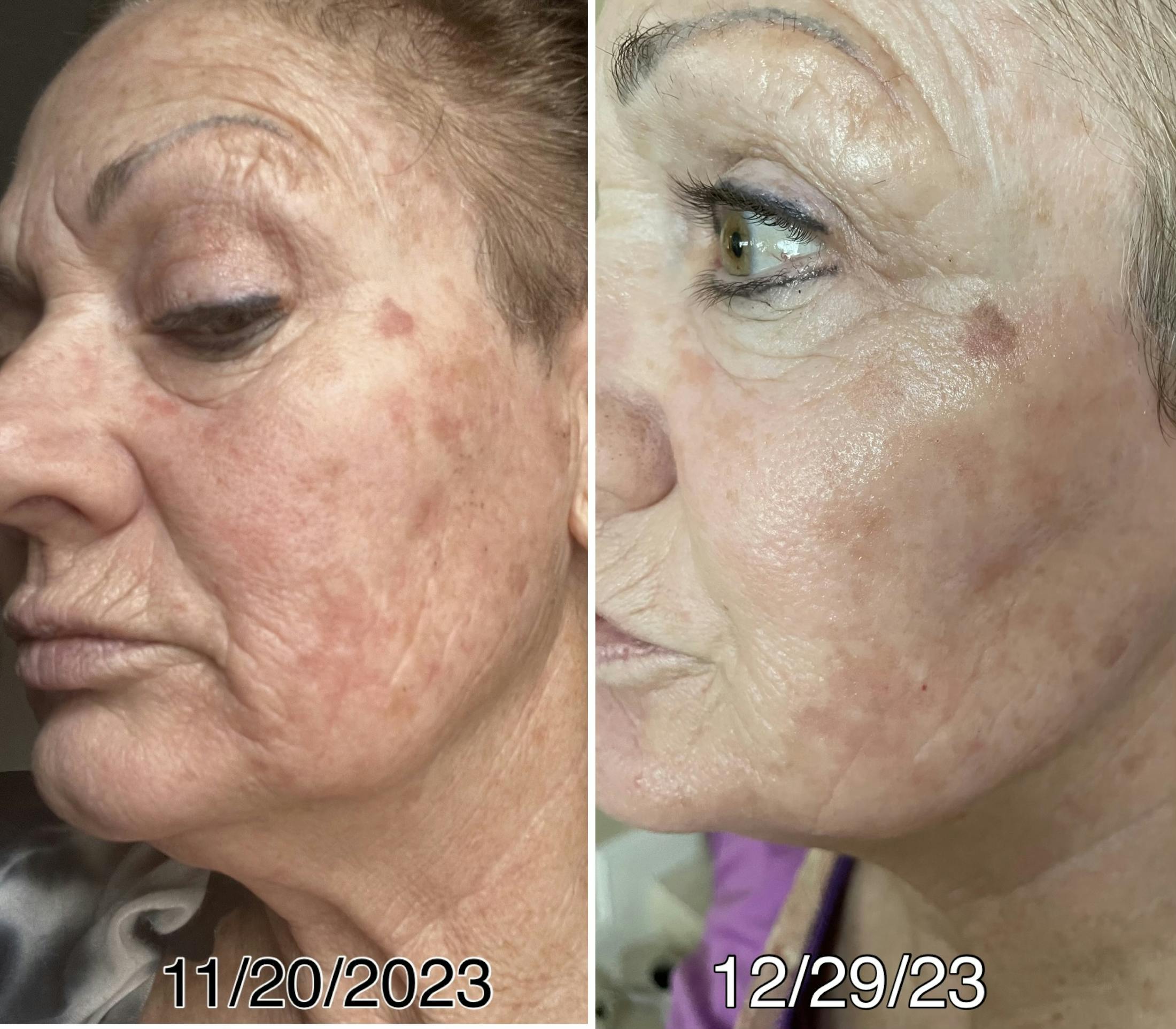 Laser Genesis IPL Before & After Gallery - Patient 205038 - Image 1