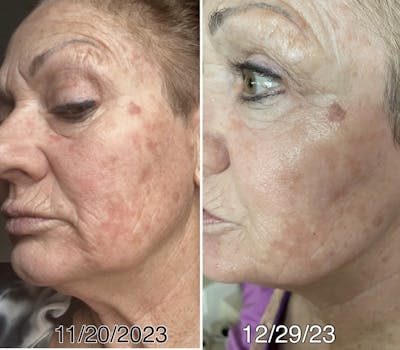 Laser Genesis IPL Before & After Gallery - Patient 205038 - Image 1