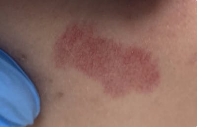 IPL Before & After Gallery - Patient 351361 - Image 1