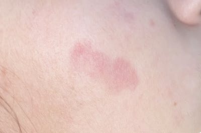 IPL Before & After Gallery - Patient 351361 - Image 2
