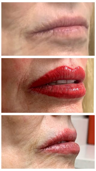 Lip Blushing Before & After Gallery - Patient 483888 - Image 6