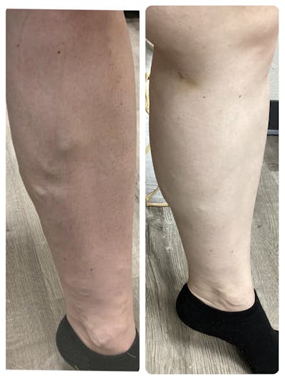 Vein Ablation Before & After Gallery - Patient 339618 - Image 1