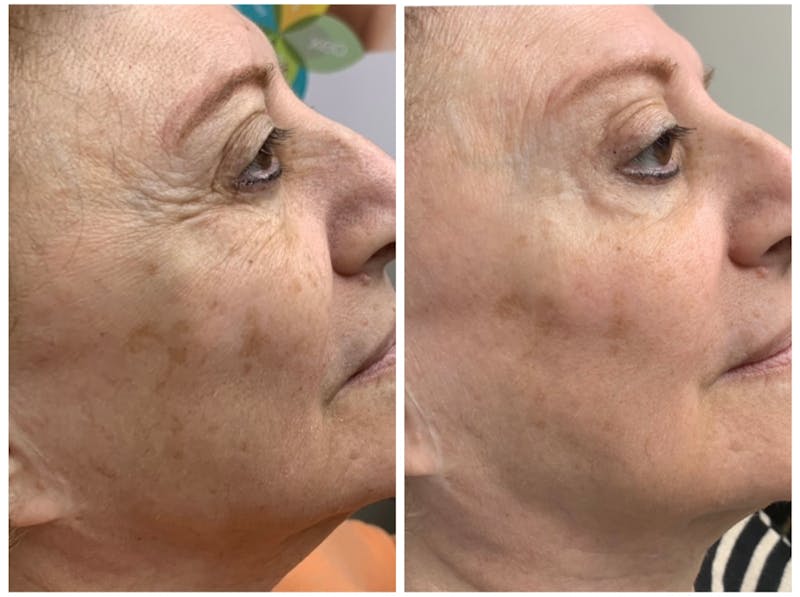 Laser Genesis Before & After Gallery - Patient 197131 - Image 1