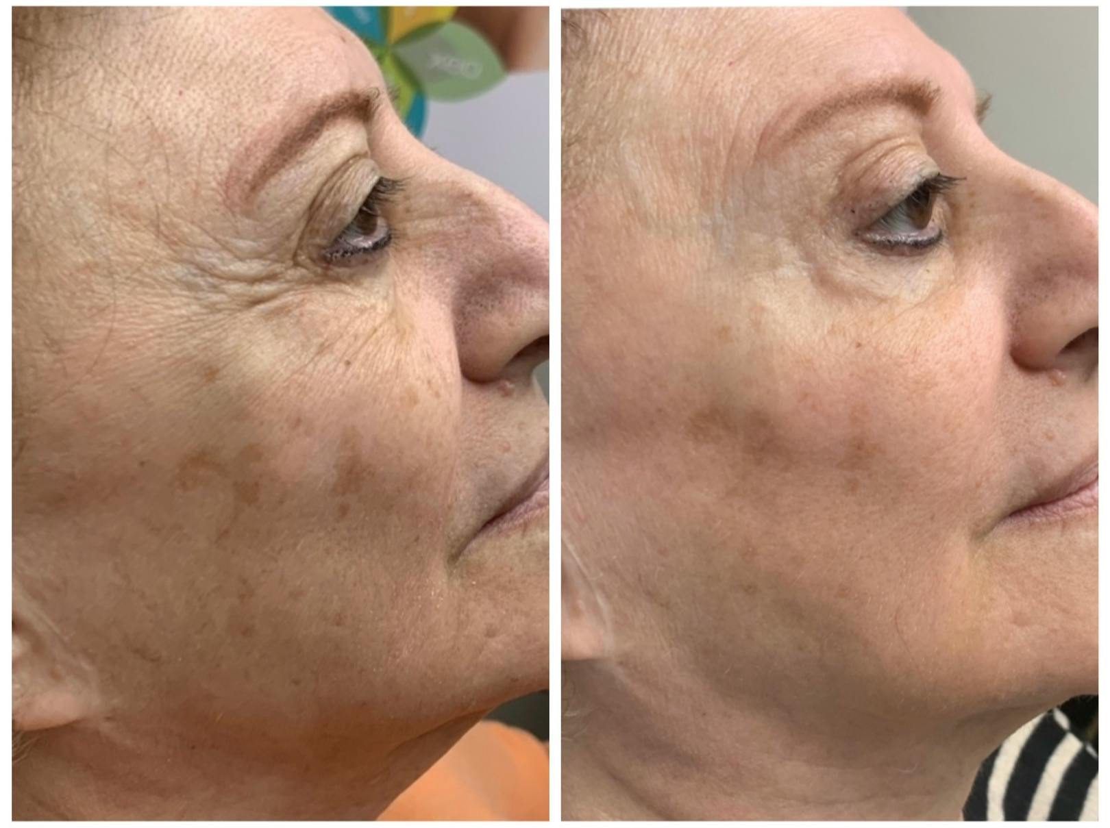 Laser Skin Rejuvenation Before & After Gallery - Patient 197131 - Image 1