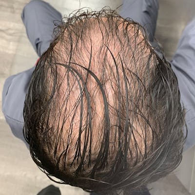 Hair Restoration Before & After Gallery - Patient 426619 - Image 2