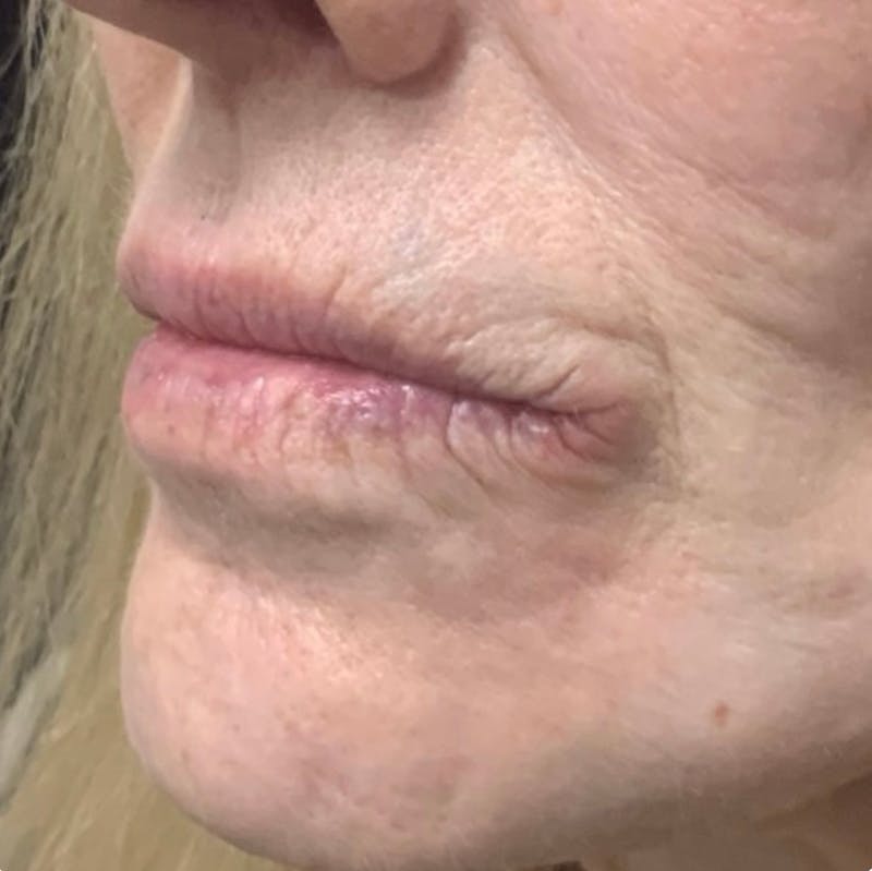 Lip Blushing Before & After Gallery - Patient 483888 - Image 3