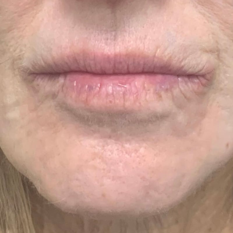 Lip Blushing Before & After Gallery - Patient 483888 - Image 1