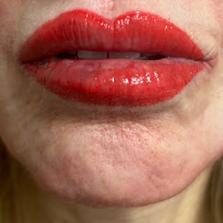 Lip Blushing Before & After Gallery - Patient 483888 - Image 2