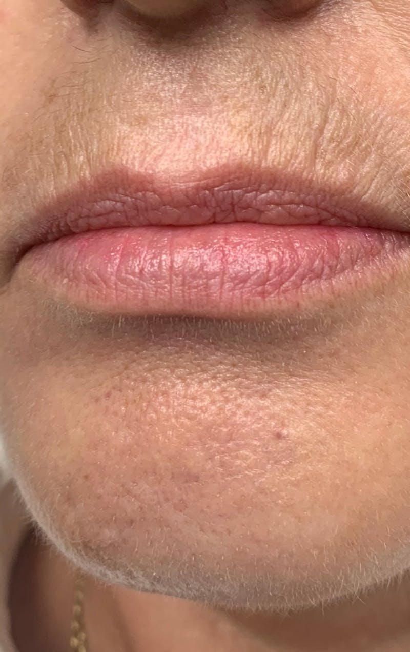 Lip Fillers Before & After Gallery - Patient 497502 - Image 1