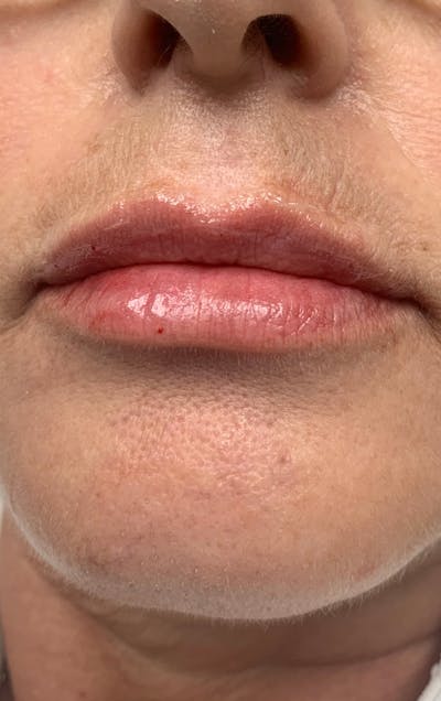 Lip Fillers Before & After Gallery - Patient 497502 - Image 2