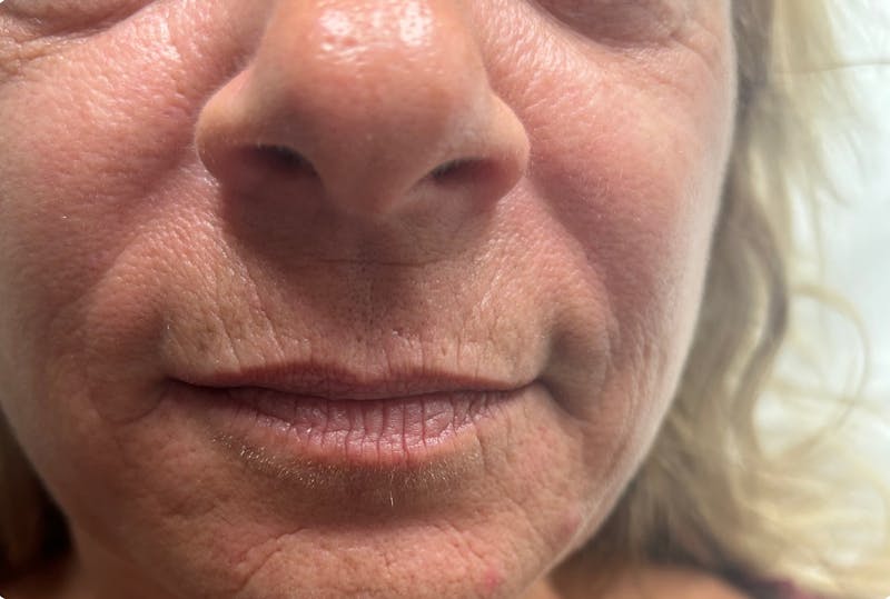 Lip Fillers Before & After Gallery - Patient 320267 - Image 1